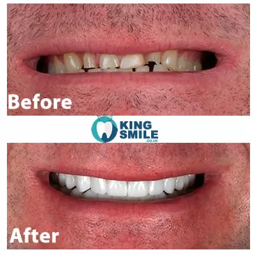 Before and After Photos Smile Makeover