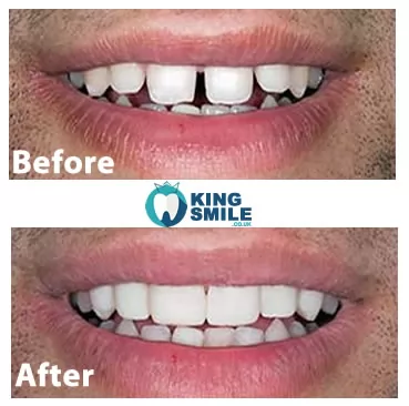 Before and After Photos Smile Makeover